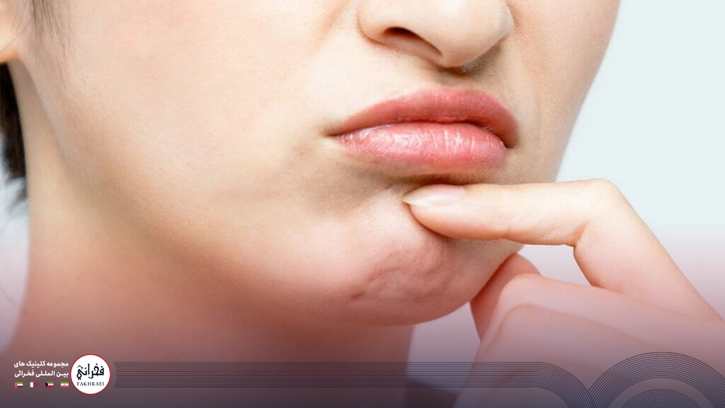 بوتاکس چانه برای چانه پرتقالی