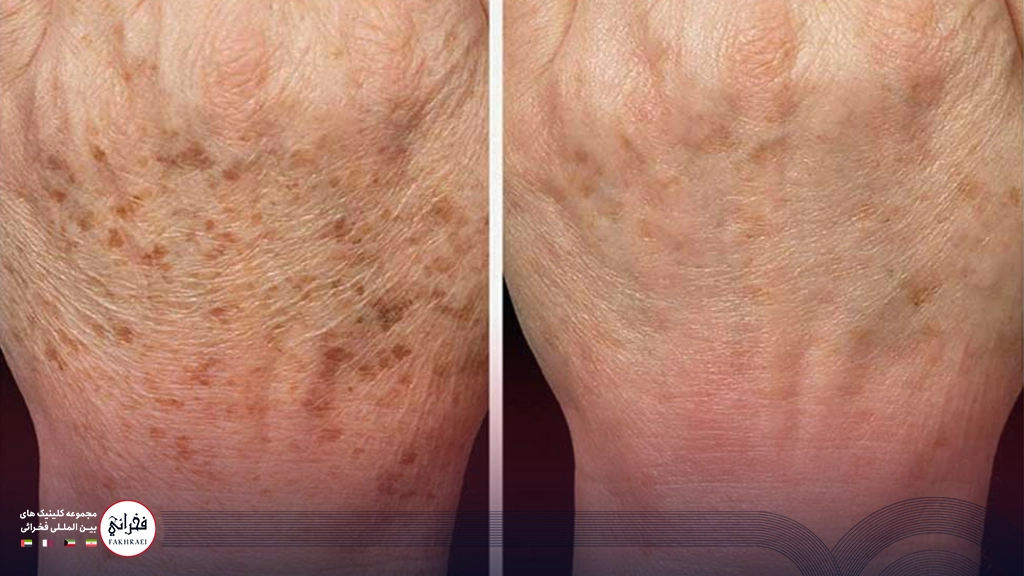 هایفوتراپی دست-نمایی از دست های خانمی قبل و بعد از هایفو