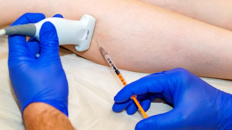 اسکلروتراپی