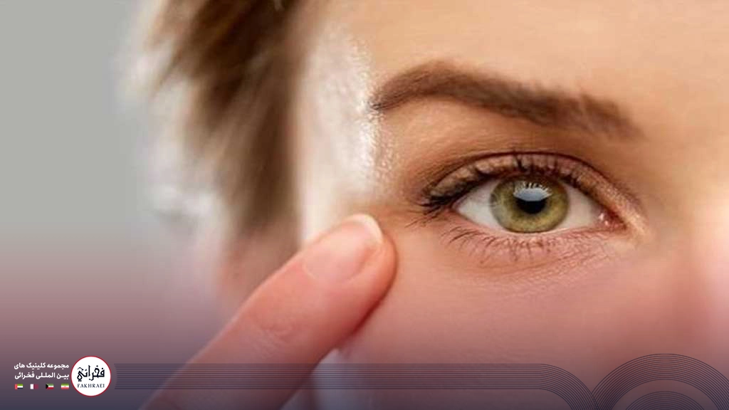 هایفوتراپی دور چشم-دور چشم خانمی با چشمان سیز