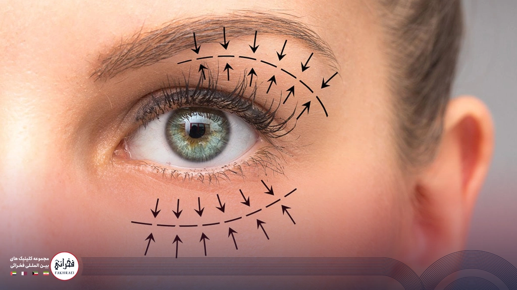 لیفت چشم با نخ