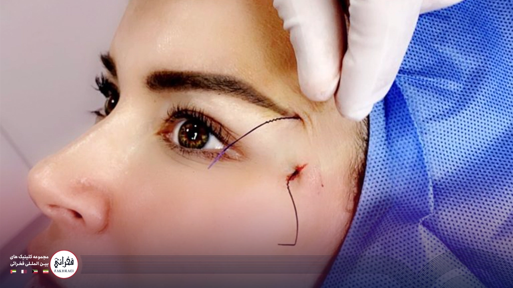 لیفت چشم با نخ -در حال لیفت چشم با نخ