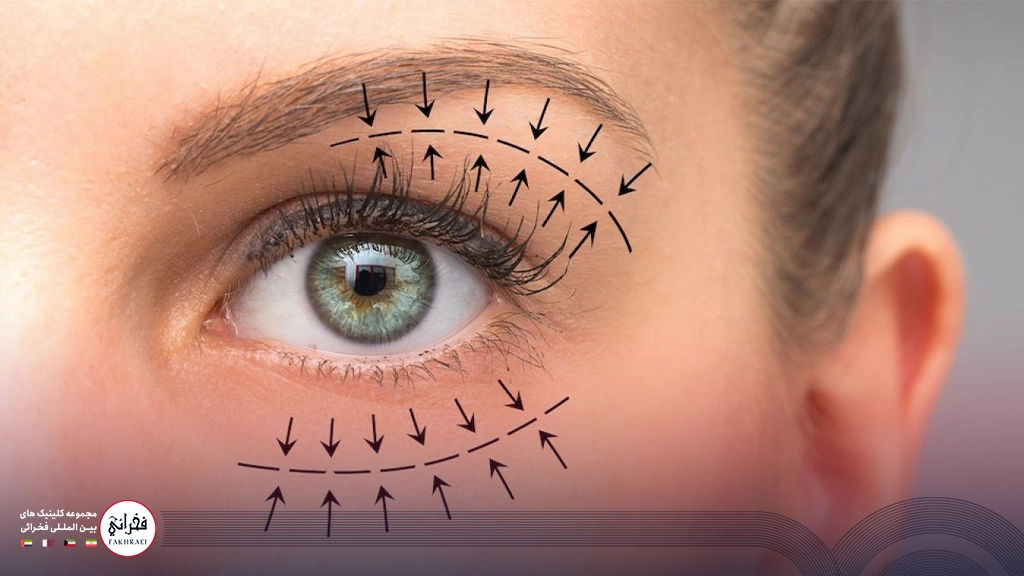 بوتاکس دور چشم-دور چشم نشانه گذاری شده خانمی