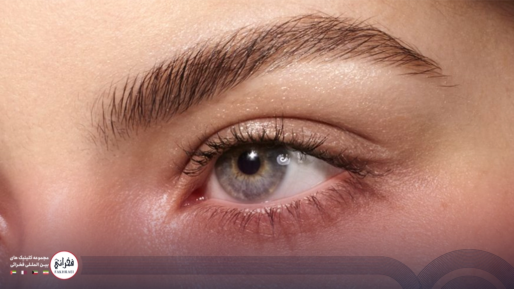 مزوتراپی ابرو -زنی با ابرو های زیبا