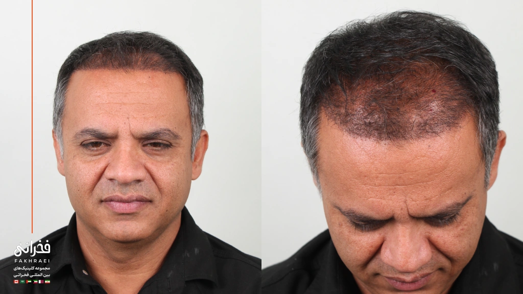 عکس ۴۰ روز بعد از کاشت مو