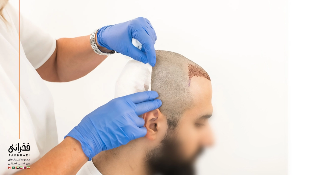مراقبت بعد از کاشت مو FIT