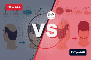 کاشت مو‌ به روش FIT بهتر است یا FUT