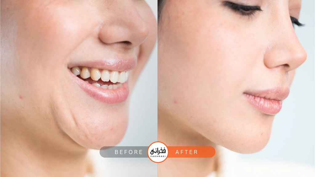 عکس ثبل و بعد از لاغری با دستگاه کول تک