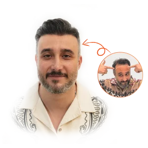 کاشت مو | کاشت موی سر