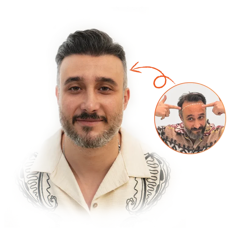 کاشت مو | کاشت موی سر