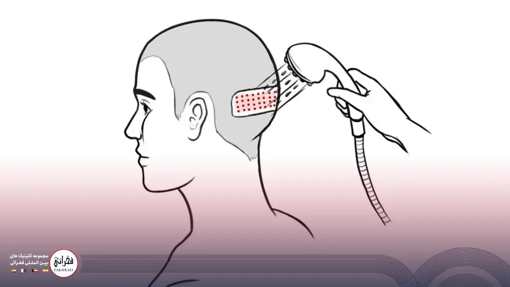 شستشوی سر بعد از کاشت مو
