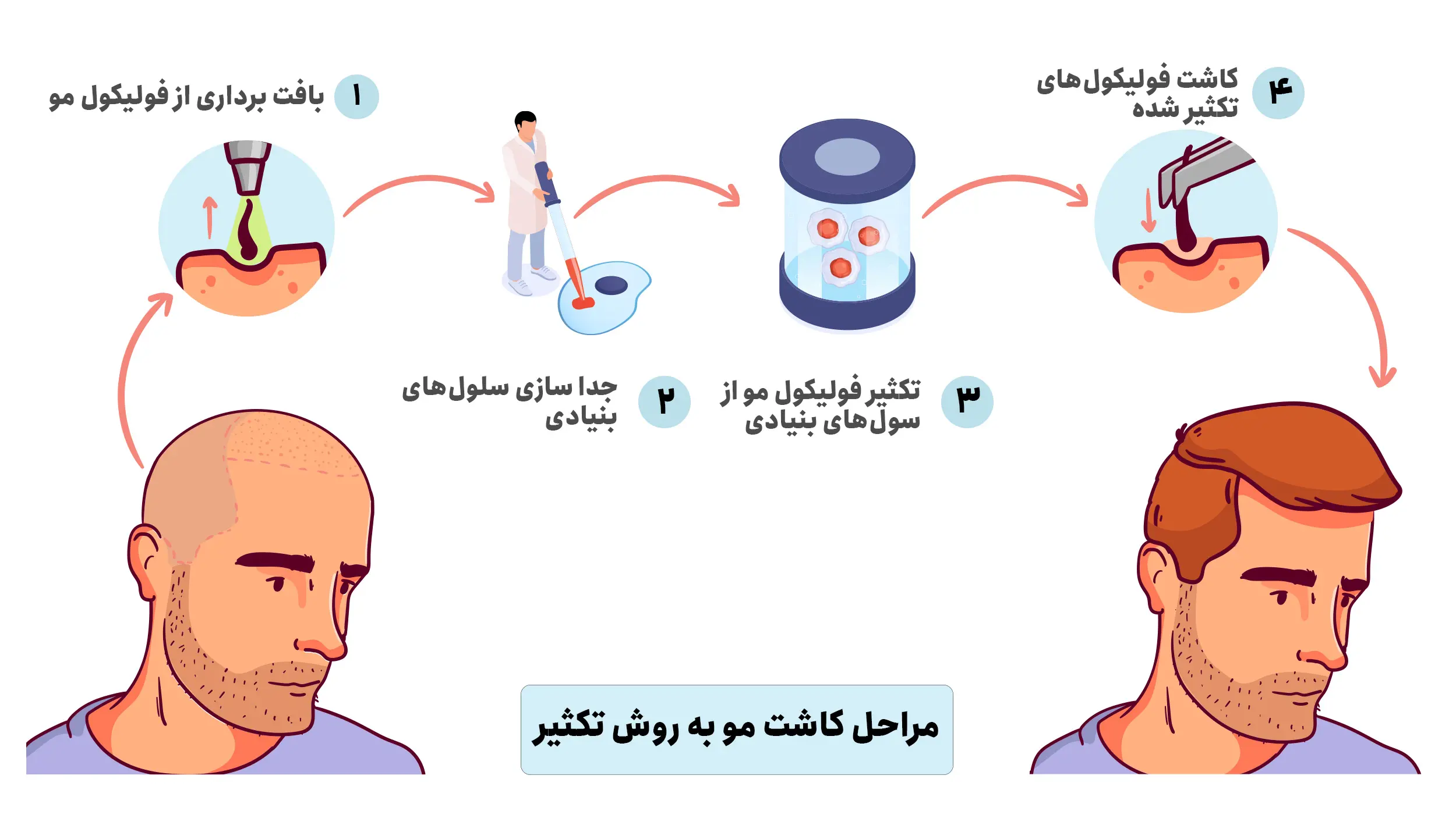 مراحل کاشت مو به روش تکثیر
