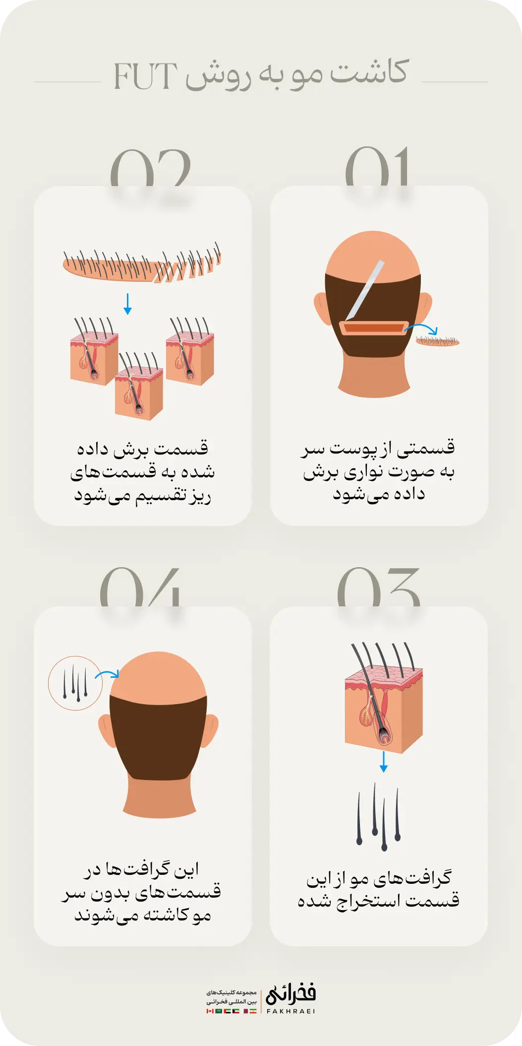 کاشت مو به روش FUT