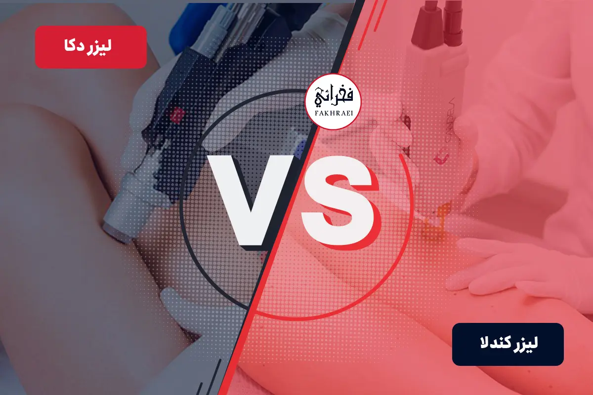 لیزر کندلا بهتره یا دکا؟
