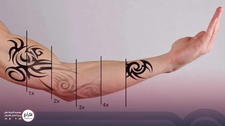 پاک کردن تاتو در منزل