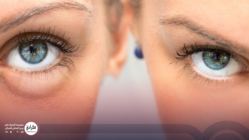 تزریق فیلر زیر چشم ممکن است عوارض داشته باشد