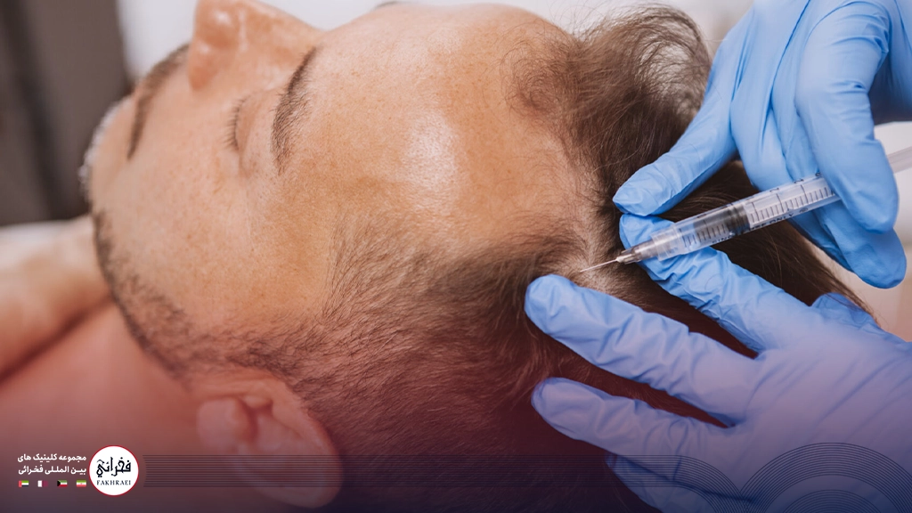 تزریق هیر فیلر برای جلوگیری از ریزش مو