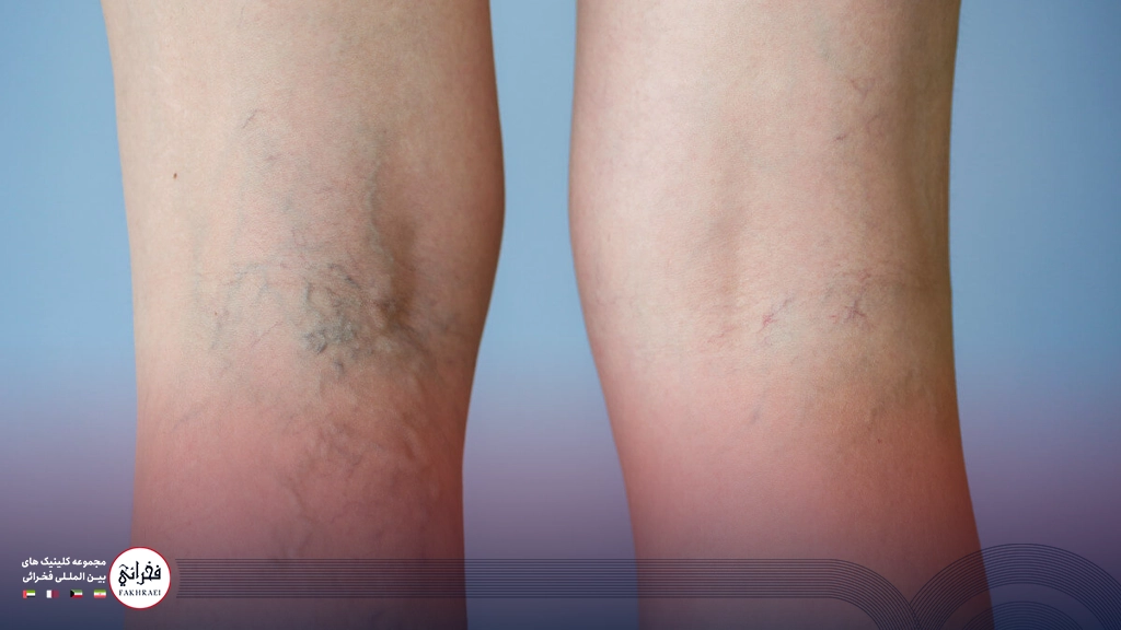 علت ایجاد واریس پا