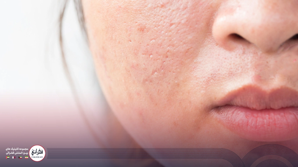 نمای نزدیک از منافذ باز و لک های پوست صورت دختری