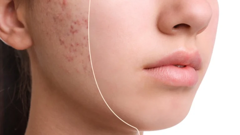 درمان لک صورت در کلینیک فخرائی