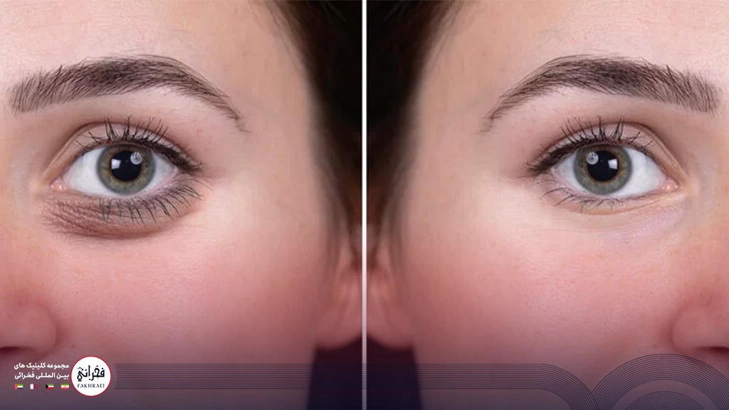 تاثیر مزوژل زیر چشم 