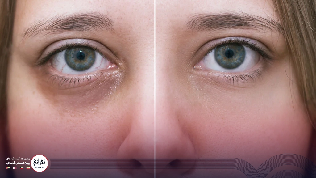 قبل و بعد از تزریق مزوژل زیر چشم