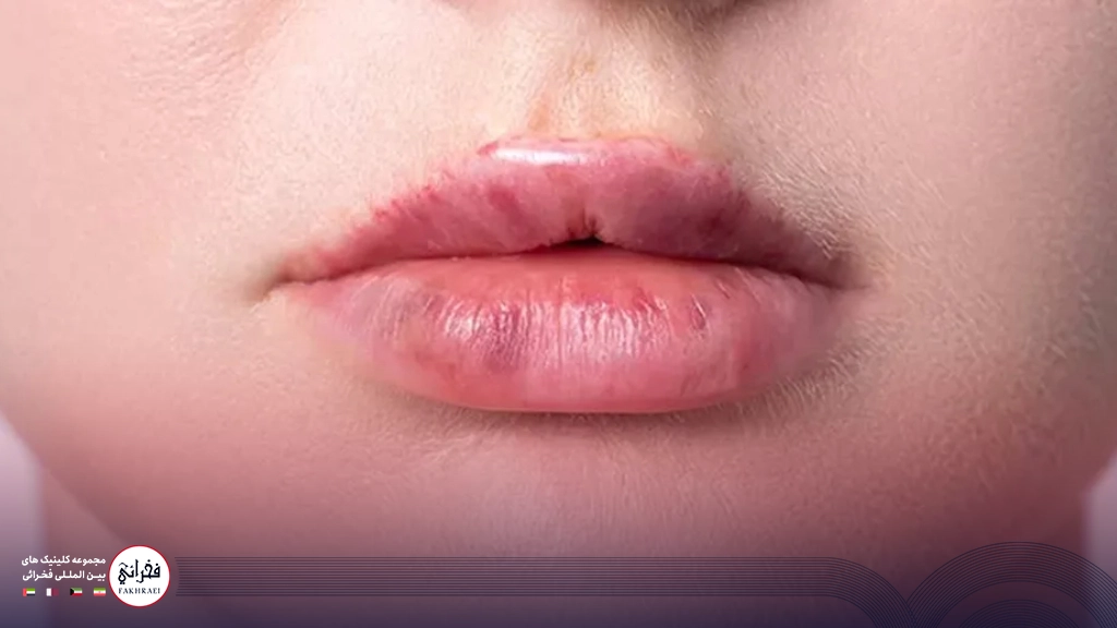 نکروز بعد از تزریق ژل