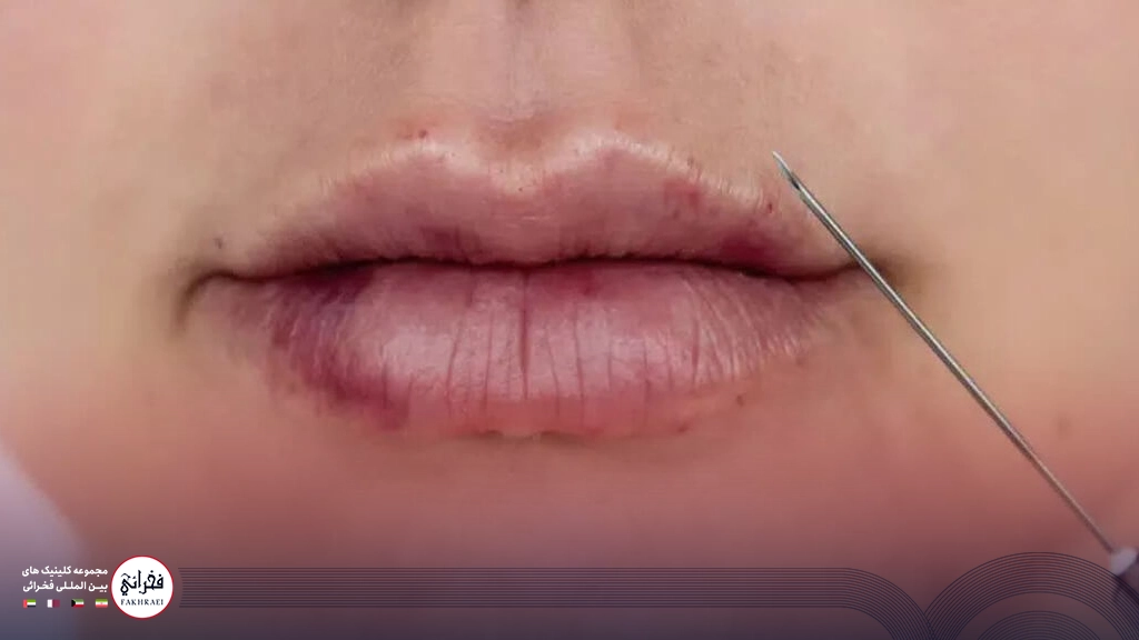 کبودی بعد از تزریق ژل لب