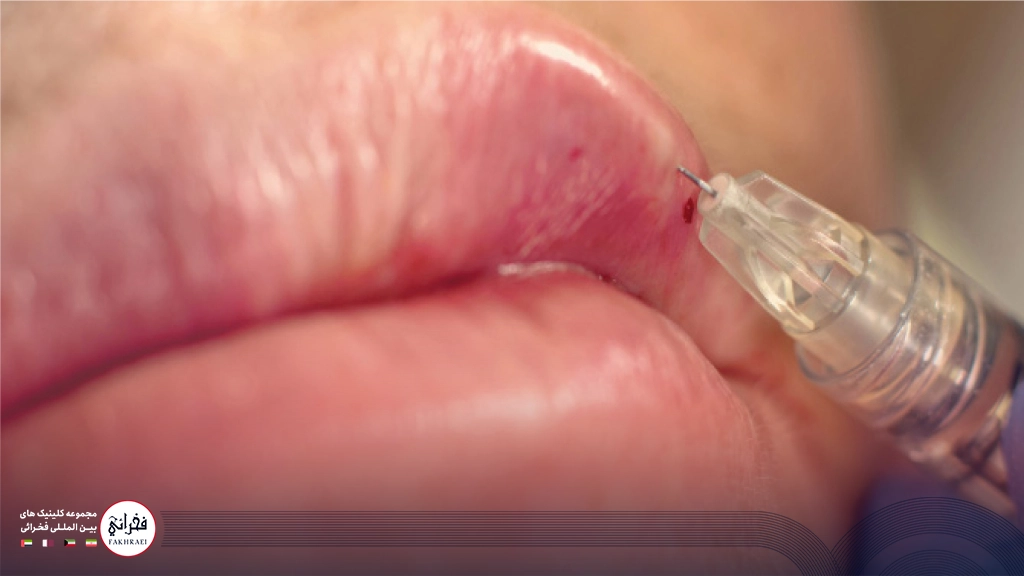 درمان نکروز بعد از تزریق ژل