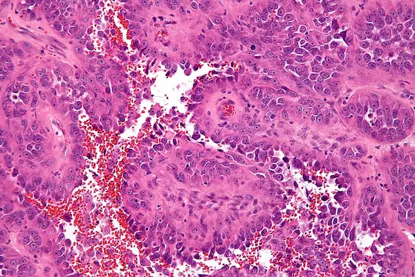 آنژیوسارکوما