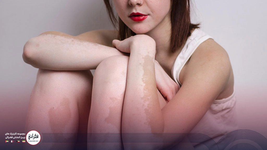 درمان پیسی دست و پای دختری 