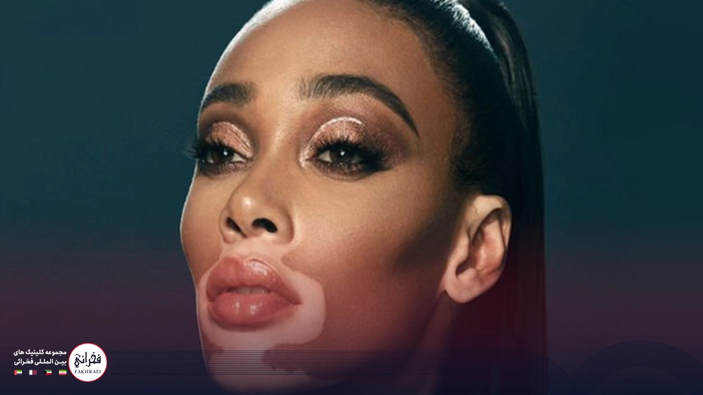 خانمی دچار پیسی در اطراف پوست دهان 