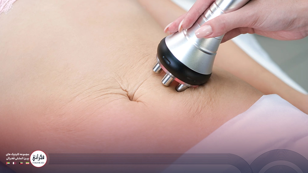 دستگاه آر اف فرکشنال روی شکم