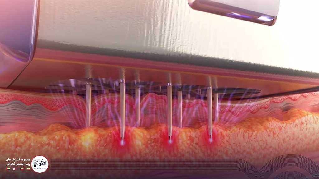 آر اف فرکشنال 