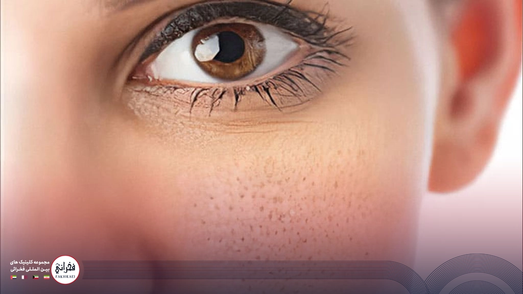 دختری با چشمان زیبا و منافذ باز روی گونه