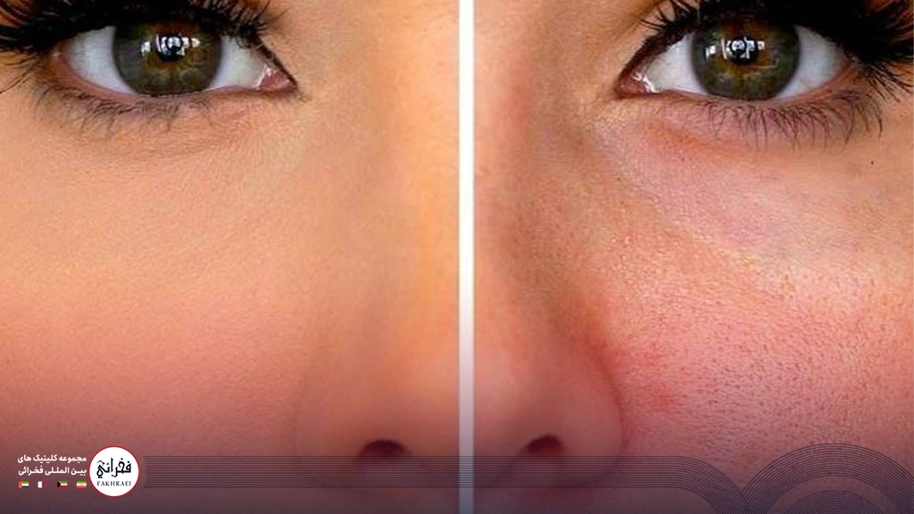 مقایسه منافذ باز و بسته پوست پس از استفاده از لیزر فوتونا