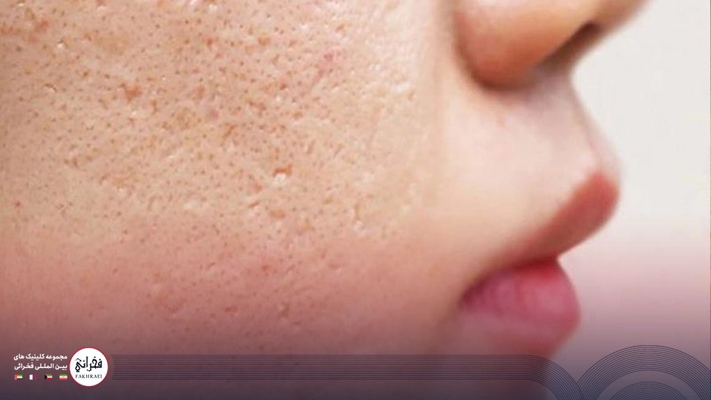 پوست خانمی با منافذ باز