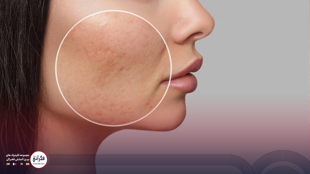 پوست خانمی با منافذ باز روی گونه