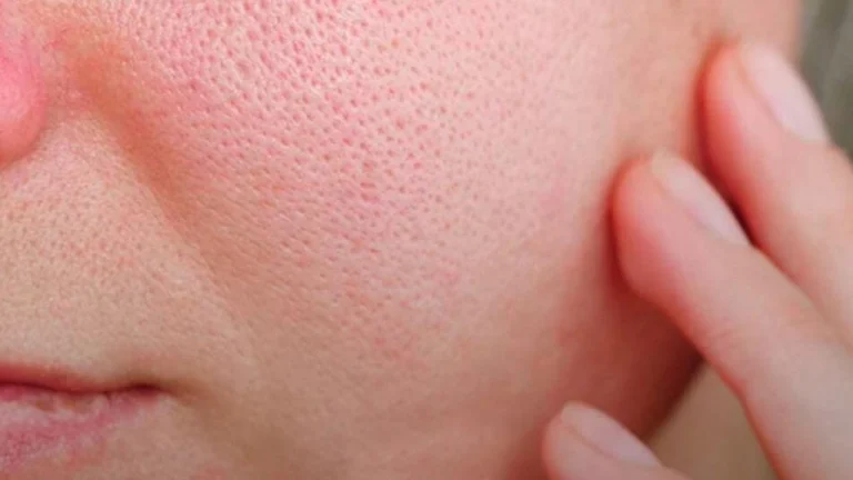 درمان منافذ باز پوست در کلینیک فخرائی