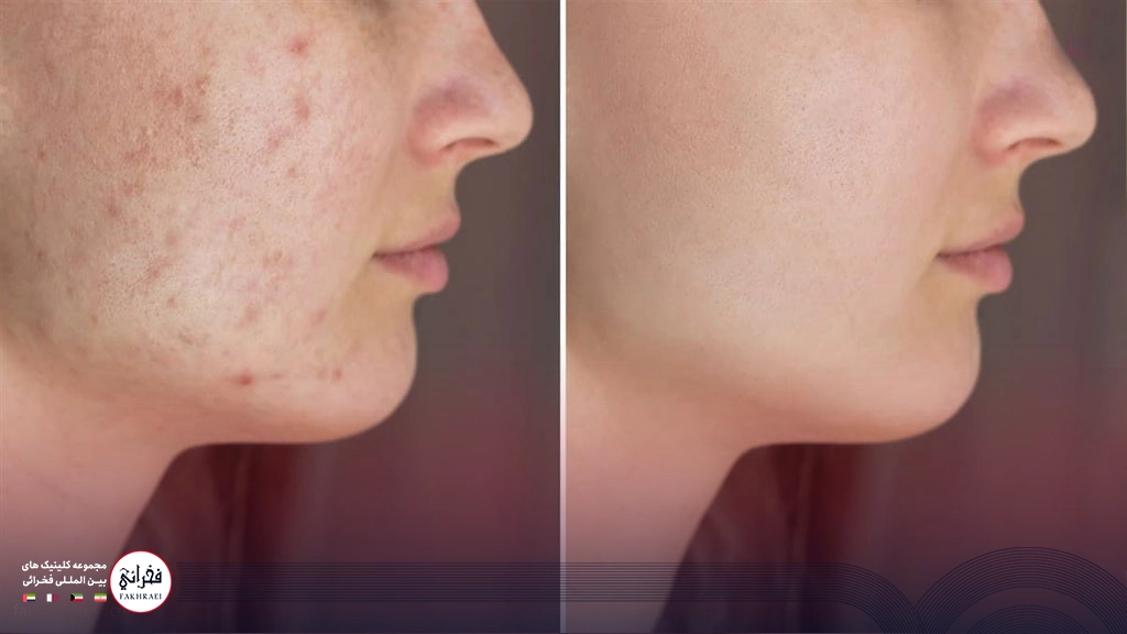 قبل و بعد منافذ باز پوست پس از لیزر co2
