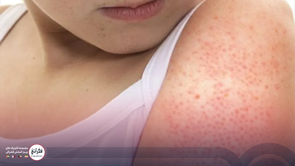 درمان پوست مرغی روی بازو