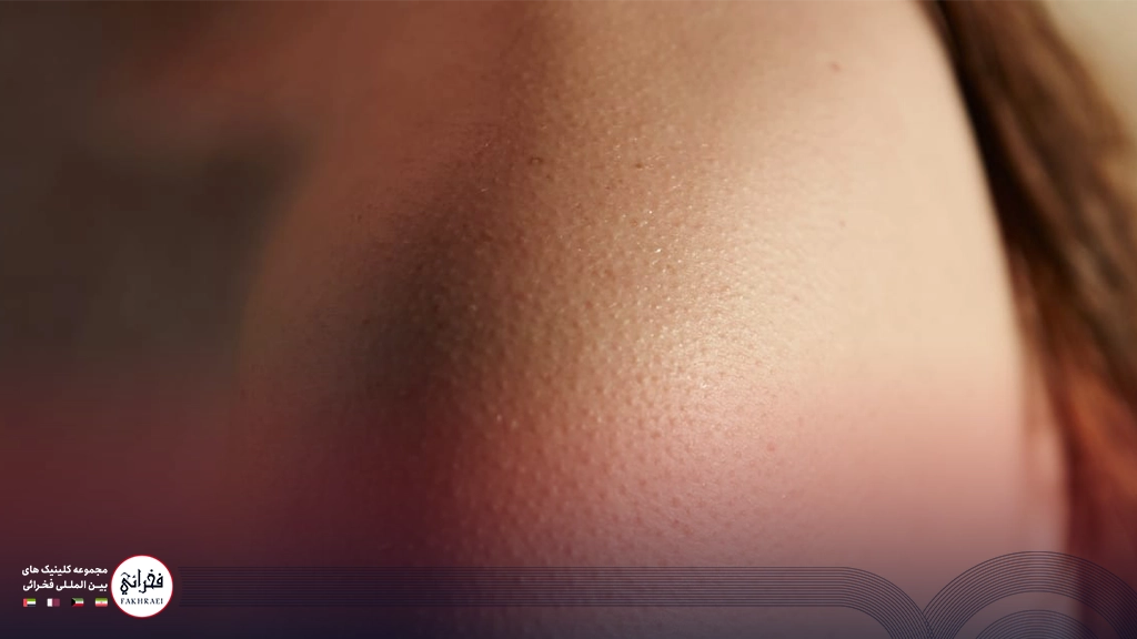 نمای نزدیک از پوست مرغی شدن شانه