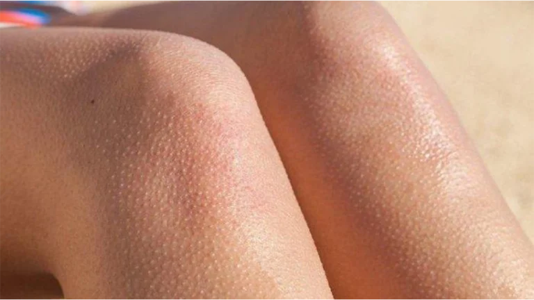 درمان پوست مرغی در کلینیک فخرائی