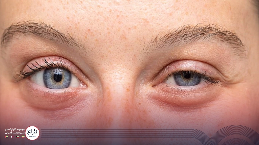 کوچک شدن چشم در اثر بوتاکس