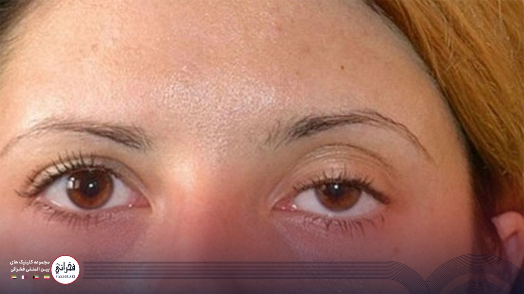 کوچک شدن چشم در اثر بوتاکس