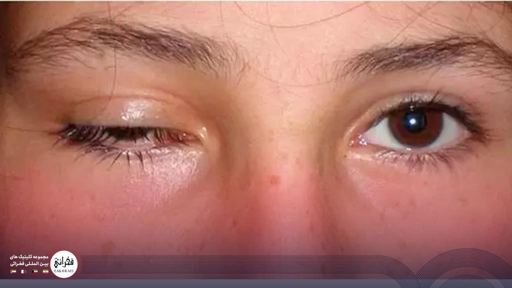 کوچک شدن یک چشم در اثر بوتاکس