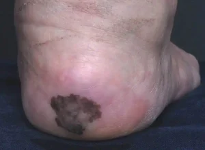 black heel disease