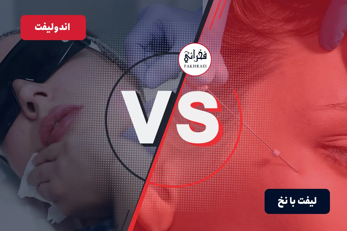 اندولیفت یا لیفت با نخ