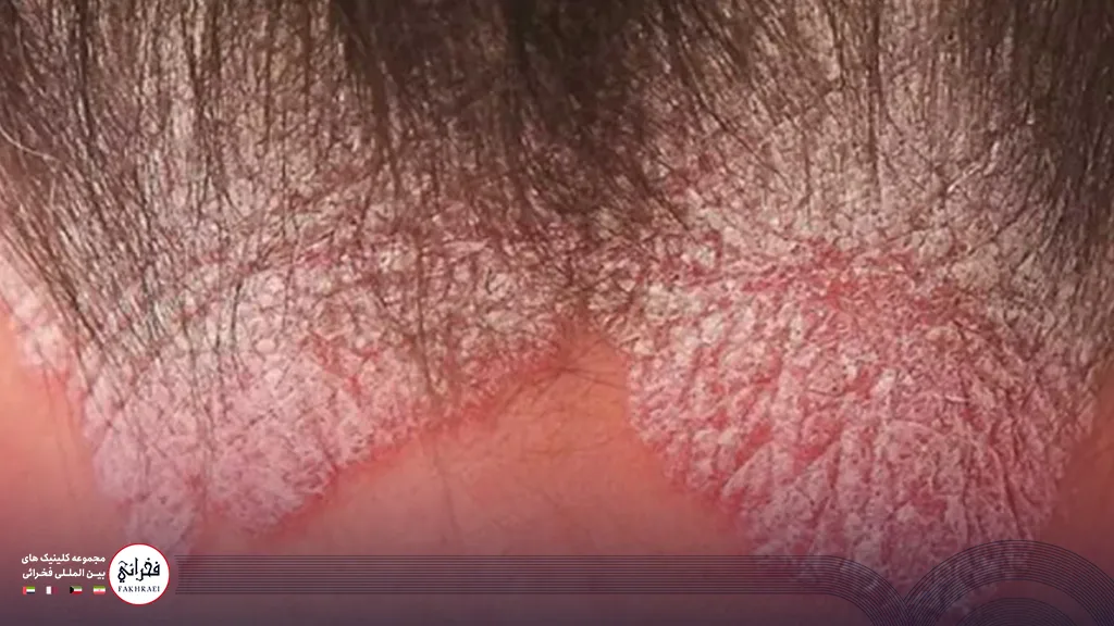 نمای نزدیک از پسوریازیس پوست سر