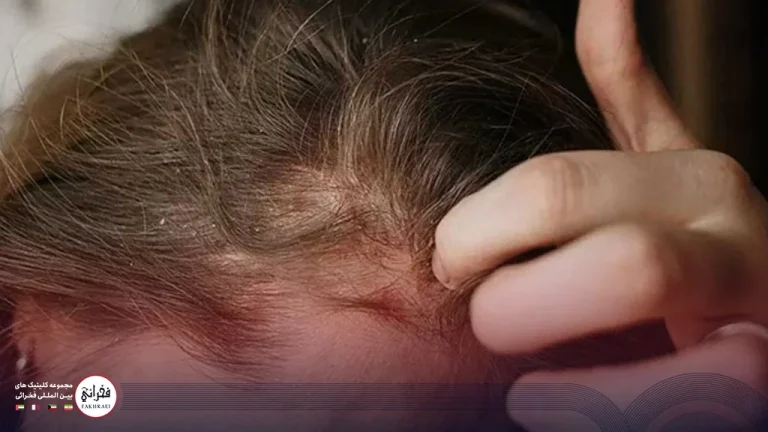 بهترین و جدیدترین روش ها برای درمان پسوریازیس پوست سر